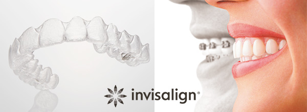 マウスピース型矯正装置インビザラインを導入