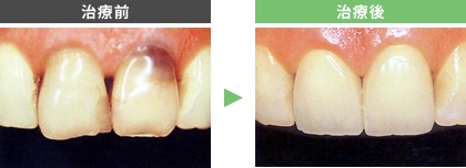 ハイブリットインレー・ハイブリットクラウン 治療前 治療後