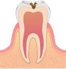 C2 象牙質の虫歯
